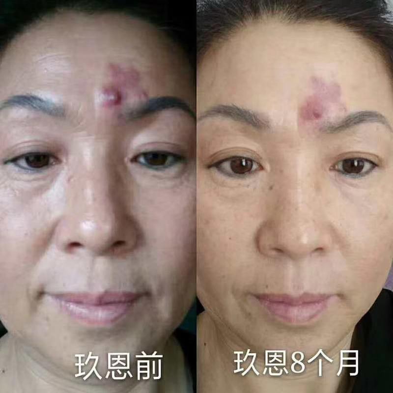 喝冻干粉可以淡化胎记吗 喝冻干粉可以淡化胎记吗女生